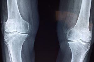 宗像整体−変形性膝関節症−レントゲン