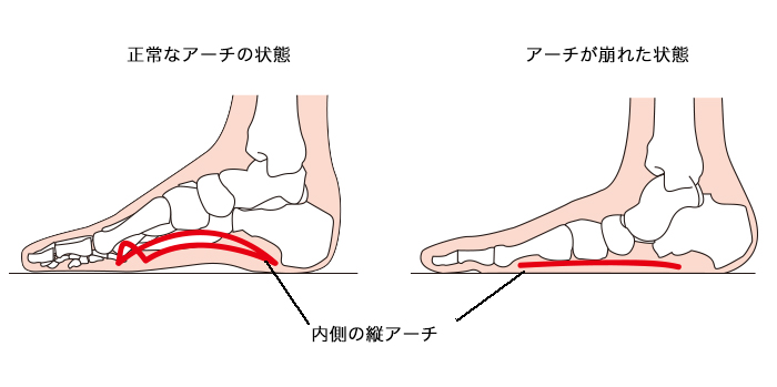 宗像整体−膝痛−扁平足−外反母趾−インソール